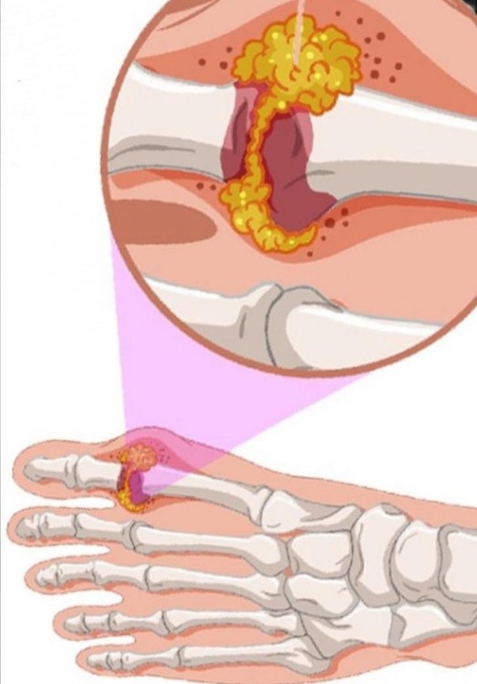 SUMIFUN Мазь для снятия болевых ощущений при вальгусной деформации суставов SUMIFUN Мазь для снятия болевых ощущений при вальгусной деформации суставов